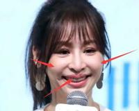 王心凌整容真相，实际是患有脸部蜂窝织炎而导致面部变形