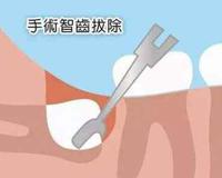 智齿不用拔的三种情况