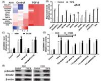 前沿研究 肺癌转移机制的新靶点lncRNAAC0269041