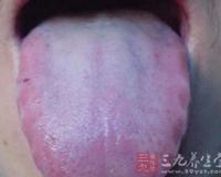 舌苔厚黄是怎么回事 舌苔厚黄是什么原因