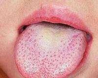 舌苔厚黄是怎么回事 舌苔厚黄是什么原因