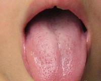 舌苔厚黄是怎么回事 舌苔厚黄是什么原因