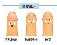 上海割包皮去什么医院好一点呢多少钱一次啊