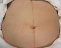 为啥女生的小腹上，都有一条褐色的缝