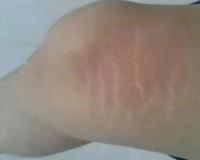 为啥女生的小腹上，都有一条褐色的缝