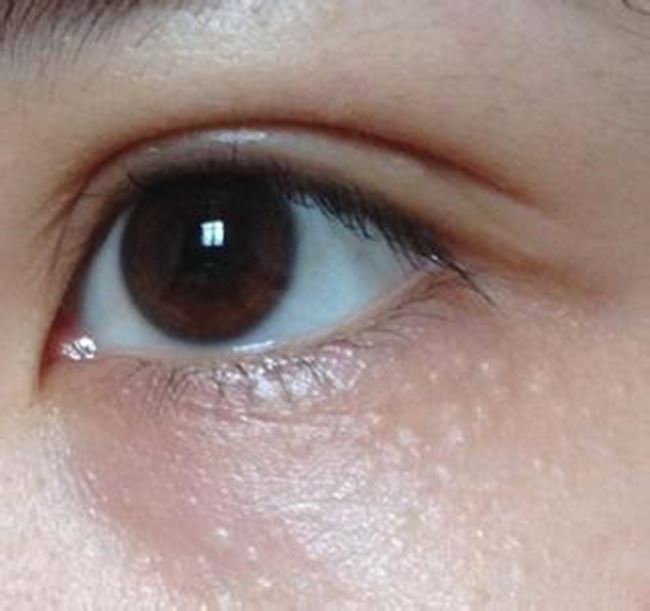 脸上脂肪粒图片 教你快速读懂脂肪粒