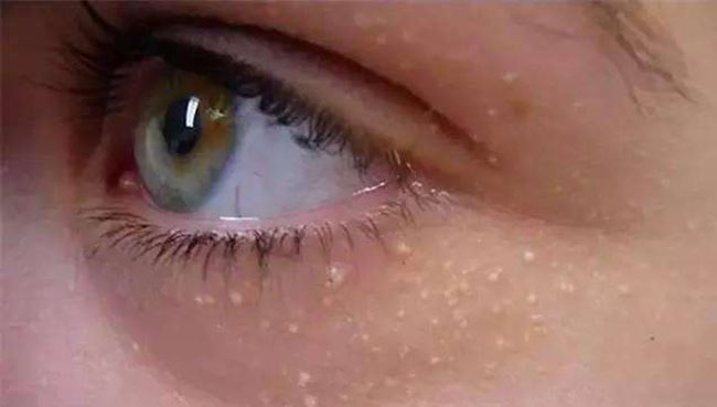 脸上脂肪粒图片 教你快速读懂脂肪粒