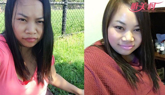 罗玉凤整容后生活现状 罗玉凤整容后照片曝光