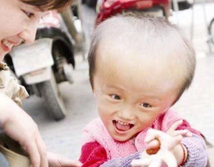 大头娃娃事件 14年过去了大头娃娃现状怎样