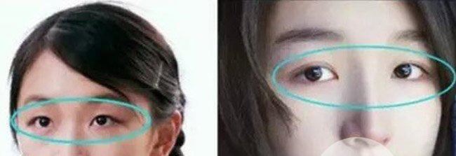 周冬雨双眼皮是割的吗 周冬雨割双眼皮前后对比