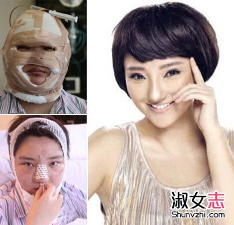 明星整容照片整容全过程