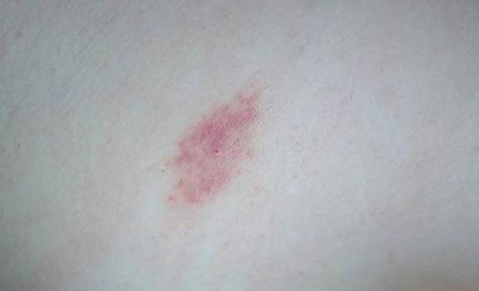 草莓印怎么快速消除 只需一小时即可快速消除草莓印