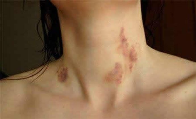 草莓印怎么快速消除 只需一小时即可快速消除草莓印