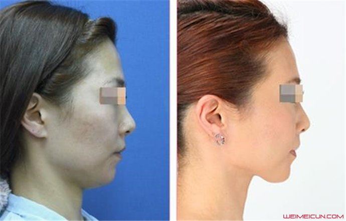 黑脸娃娃效果对比 黑脸娃娃效果怎么样