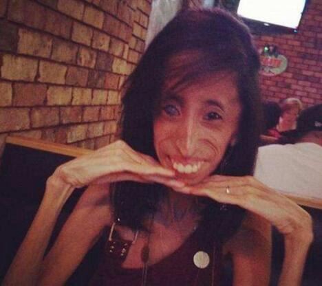 美国零脂肪女孩 丽兹·维拉斯奎兹(体重仅仅只有54斤)