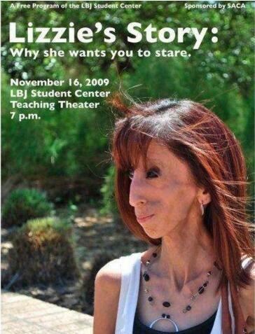 美国零脂肪女孩 丽兹·维拉斯奎兹(体重仅仅只有54斤)