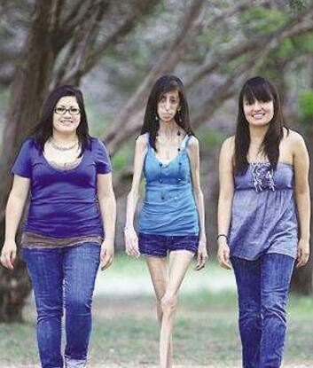 美国零脂肪女孩 丽兹·维拉斯奎兹(体重仅仅只有54斤)