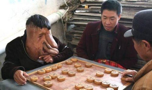 世界上最大的“像面人” 黄春才(面部肿瘤达30余斤)