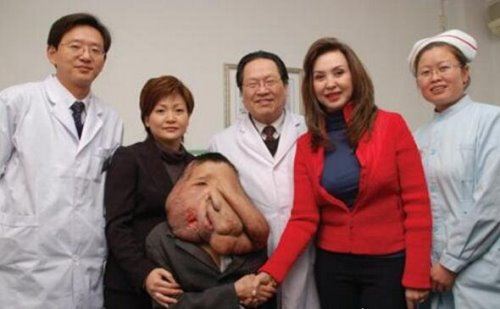世界上最大的“像面人” 黄春才(面部肿瘤达30余斤)
