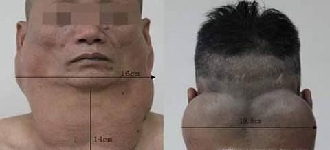 什么是马德龙病