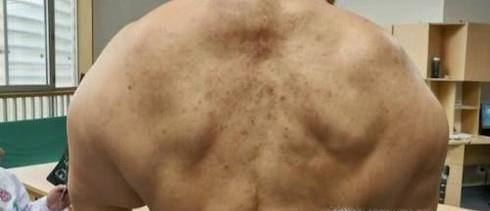 什么是马德龙病