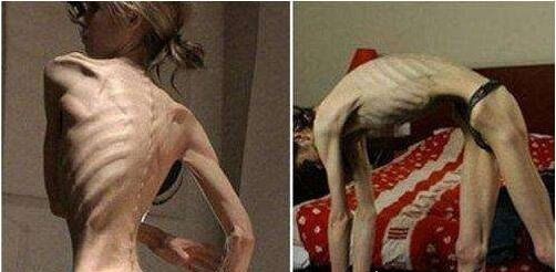 世界上最瘦的人 俄罗斯25岁少女仅40斤(减肥成干尸)