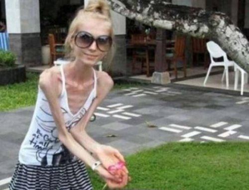 世界上最瘦的人 俄罗斯25岁少女仅40斤(减肥成干尸)