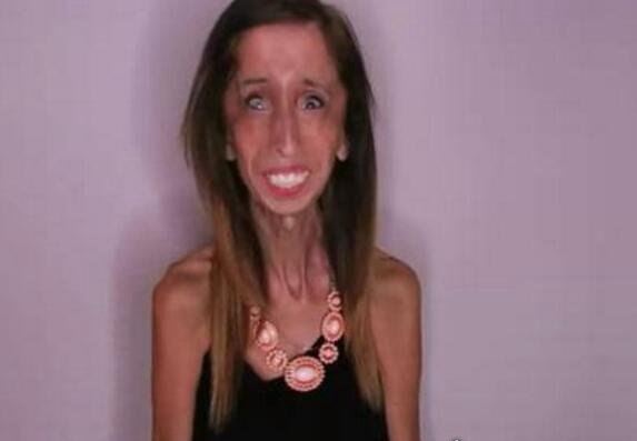 世界上最瘦的人 俄罗斯25岁少女仅40斤(减肥成干尸)