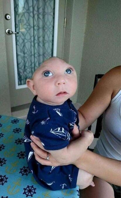 奇迹宝宝尼古拉斯·柯克 世界上首个活过了3年的无脑儿