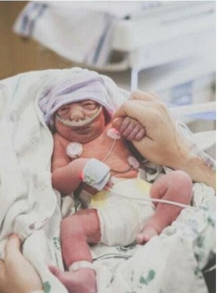 奇迹宝宝尼古拉斯·柯克 世界上首个活过了3年的无脑儿