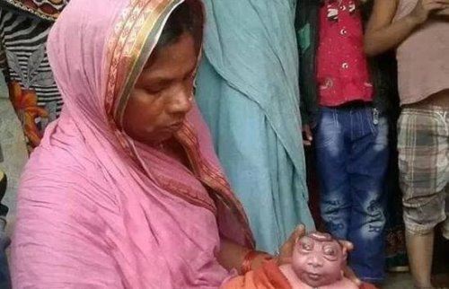 奇迹宝宝尼古拉斯·柯克 世界上首个活过了3年的无脑儿