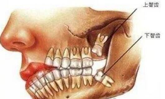 不需要拔的智齿图片 这4种情况下的智齿其实并不需要拔