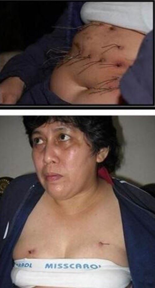 世界上科学解释不了的事 印尼女子一夜长出10公分铁丝