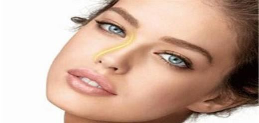 假体隆鼻后效果自然吗？