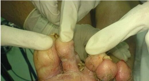 史上最恶心的图片 莲蓬乳/空手指超恶心图片合集(慎入)