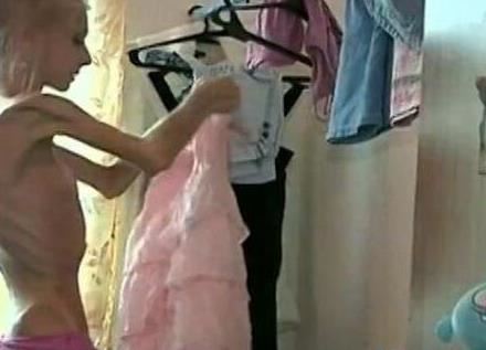 世界上最瘦的人 俄罗斯女孩高158cm重20公斤