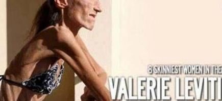 世界上最瘦的人 俄罗斯女孩高158cm重20公斤