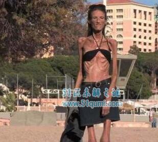 世界上最瘦的人，俄罗斯女孩Kseniya Bubenko只有20公斤