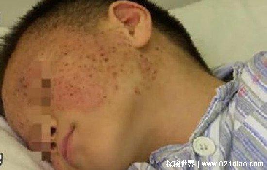 玉米男孩恐怖图片，皮肤被寄生虫感染（现实生活中真实存在）