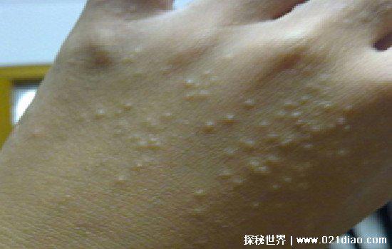 玉米男孩恐怖图片，皮肤被寄生虫感染（现实生活中真实存在）