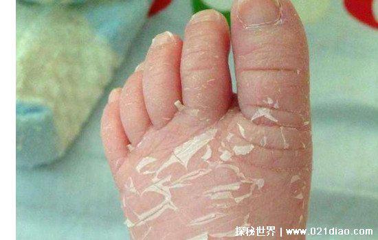 玉米男孩恐怖图片，皮肤被寄生虫感染（现实生活中真实存在）