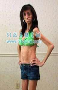 零脂肪女孩:丽兹·维拉斯奎兹 零脂肪女孩是什么病?