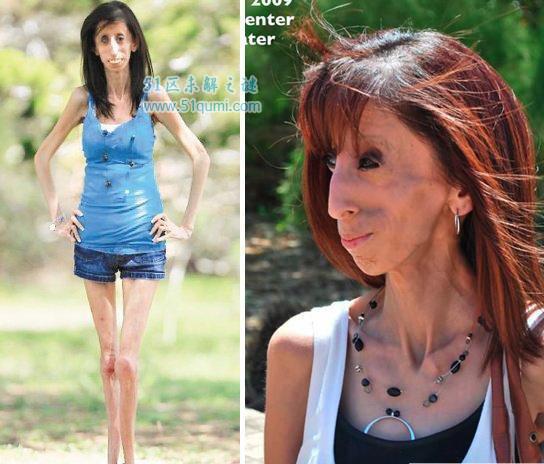 零脂肪女孩:丽兹·维拉斯奎兹 零脂肪女孩是什么病?