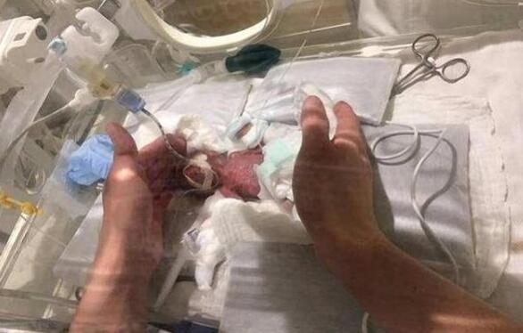 世界上最小的婴儿是谁，阿米利娅·泰勒(不到300克)