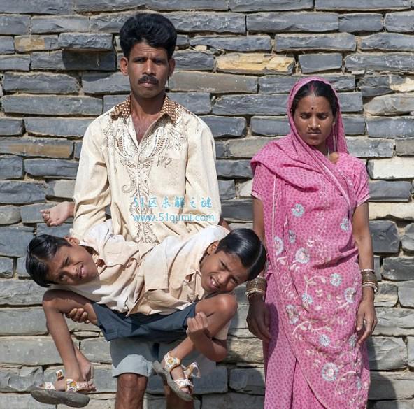 印度连体兄弟拒绝分离 兄弟两人共享4只胳膊和2条腿