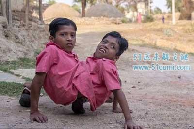 印度连体兄弟拒绝分离 兄弟两人共享4只胳膊和2条腿