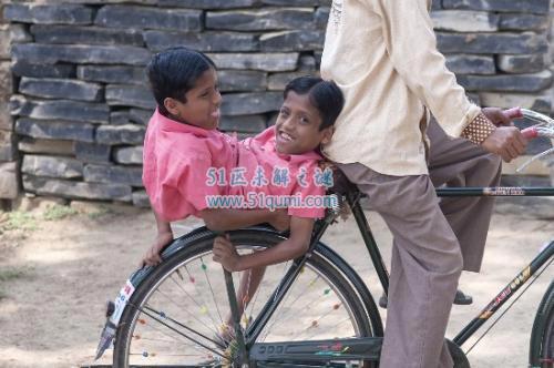 印度连体兄弟拒绝分离 兄弟两人共享4只胳膊和2条腿