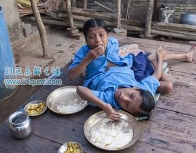 印度连体兄弟拒绝分离 兄弟两人共享4只胳膊和2条腿