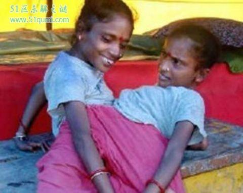 印度连体兄弟拒绝分离 兄弟两人共享4只胳膊和2条腿