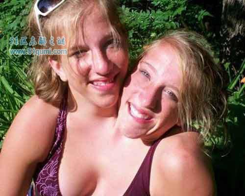 印度连体兄弟拒绝分离 兄弟两人共享4只胳膊和2条腿